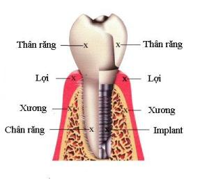 Phục hình răng sau khi nhổ răng sâu