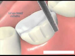 Bọc răng sứ có đau không? Boc-rang-su-co-dau-khong-01