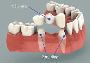 Những giải pháp phục hình tình trạng mất răng vĩnh viễn