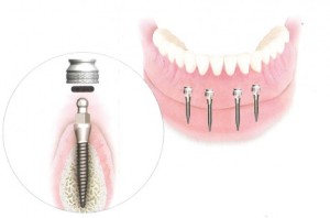 Những giải pháp phục hình tình trạng mất răng vĩnh viễn Nhung-giai-phap-phuc-hinh-tinh-trang-rang-mat-rang-vinh-vien